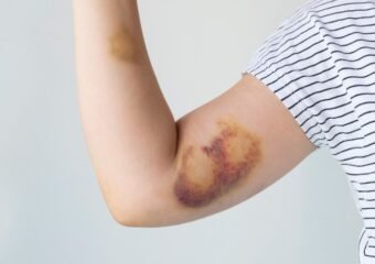 bruise detection technology